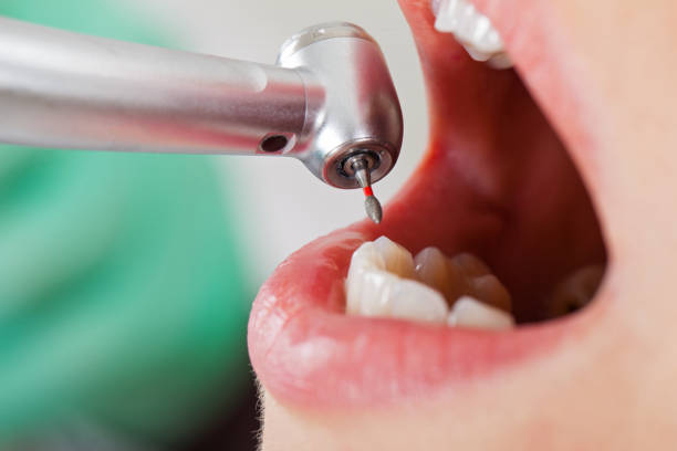 Best Knocked-Out Tooth (Avulsed Tooth) Treatment in Rogers, TX